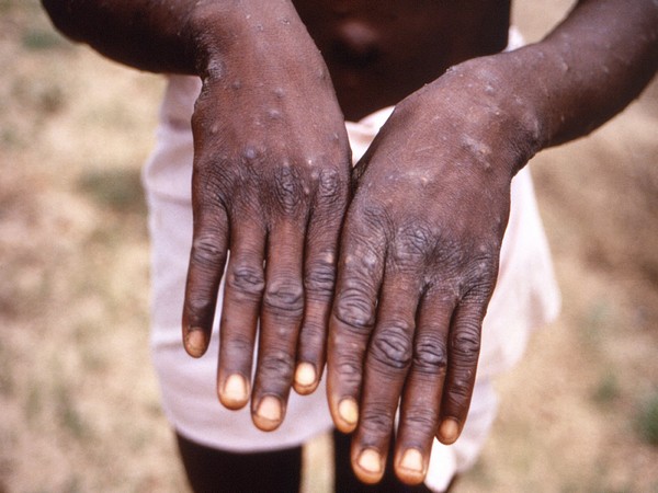 new-clinical-symptoms-in-confirmed-monkeypox-cases-identified
