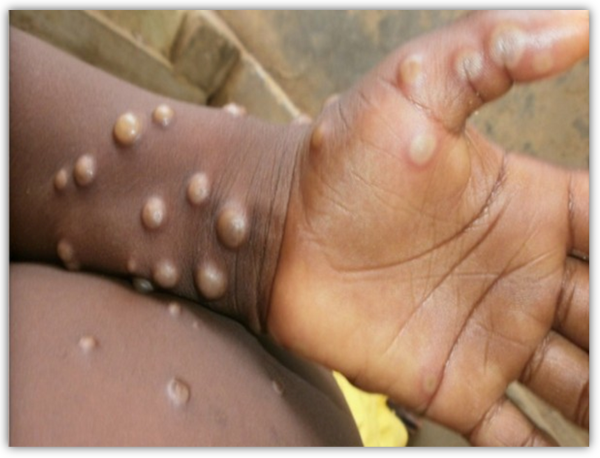 five-year-old-girl-in-ups-ghaziabad-with-suspected-monkeypox-infection-tests-negative
