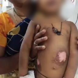 Parents pour hot oil over their three-year-old daughter; police arrest duo